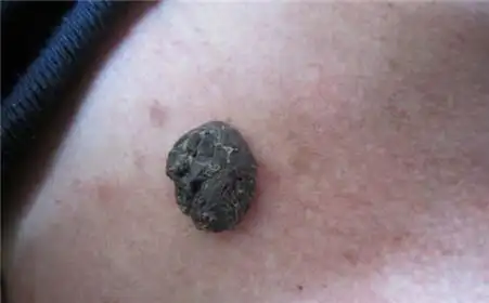 小小黑痣突变成癌