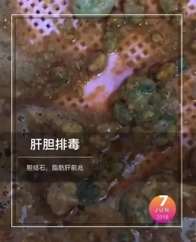 排出来胆结石,脂肪肝前兆物,还有油包!这些在你体内,怎健康!