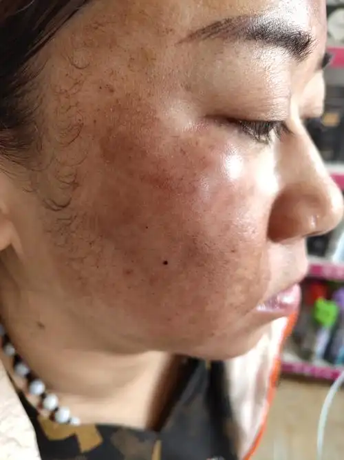 真皮斑的全过程