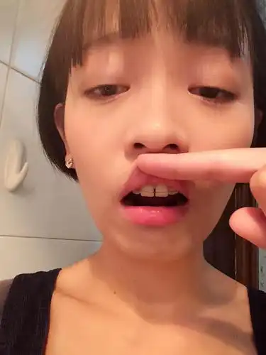 就是这样阿,门牙缝忍不了,29碎的大龄牙套君蛋生啦