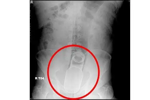 瓶子塞肛门险酿肠穿孔