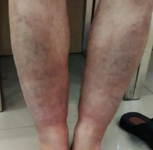 甲减导致的粘液性水肿怎么减呀求助