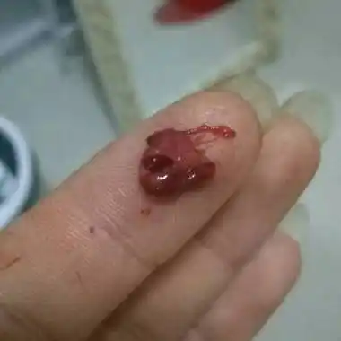 怀孕初期出血,先兆流产.