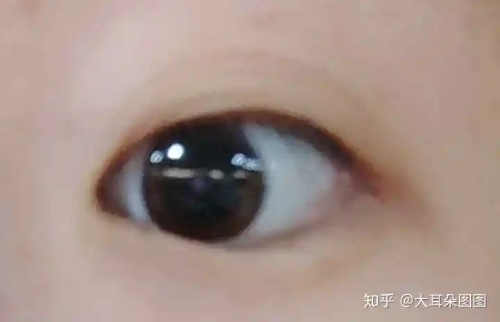 散瞳过程中,可以看到眼睛里的黑色部分已经非常非常大了接近棕色的