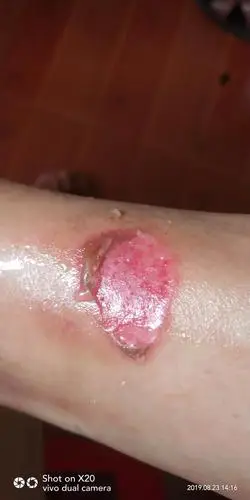 脚踝被高温铁器烫伤