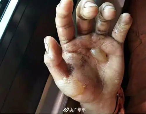 森警战士左手烧伤引网友泪奔 受伤后一直坚守一线