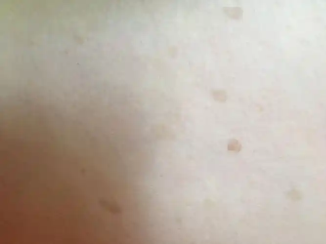 大腿跟内两侧长了好多斑是怎么回事啊?