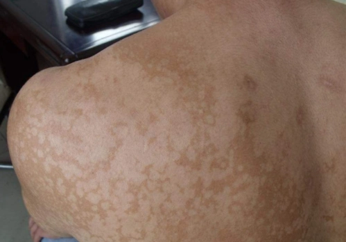 夏天发作汗斑中医治疗效果好吗?