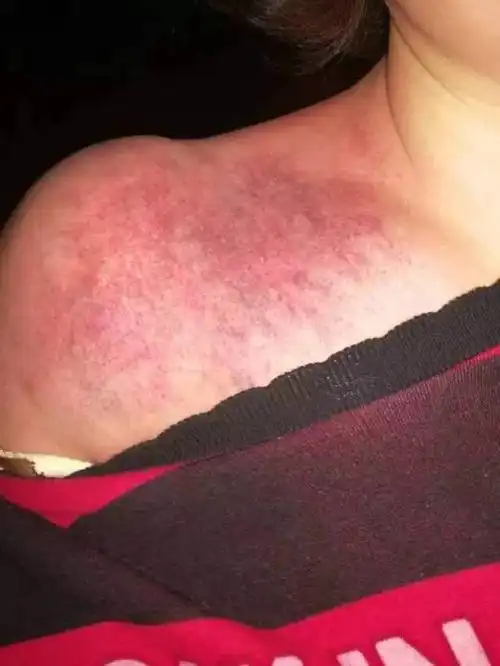 多年的肩周炎患者,来北碚公园拍打出痧后肩膀轻松了.