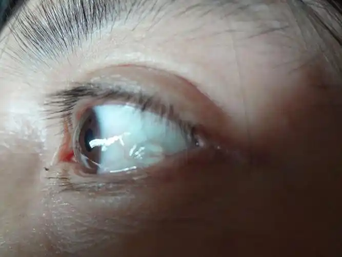 眼球上白色部分上面长了一个透明水泡,是