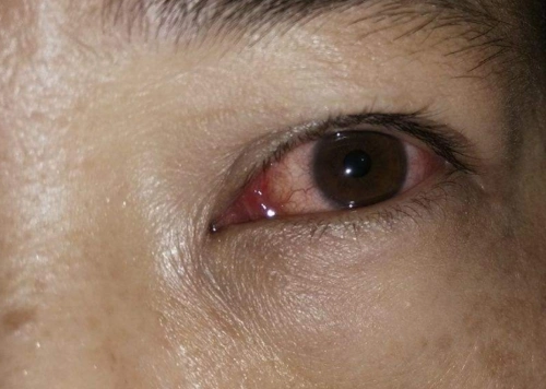 眼睛流血图片 (2)_有来医生