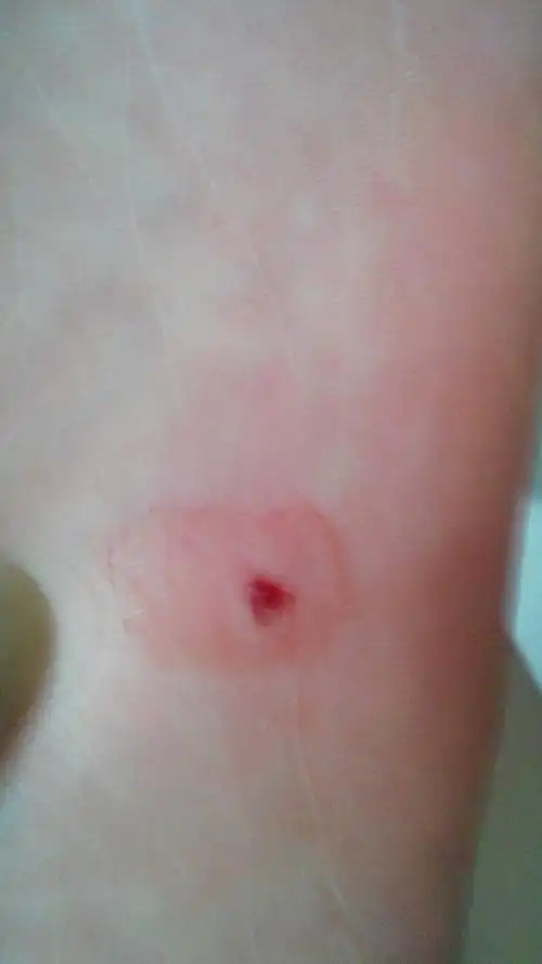 2014-01-24 赵洪顺 医师 脚底