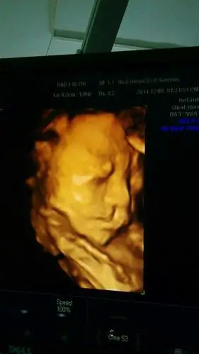 [广西妈妈帮]我放弃了有唇裂伴有鄂裂的宝宝.