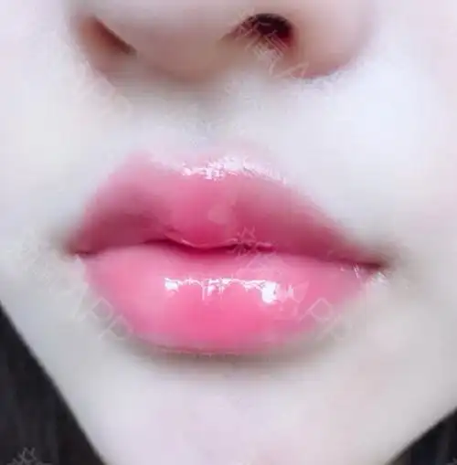 唇好不好_效果图_氧气35712926480玻尿酸丰唇术后第3天_新氧美容整形