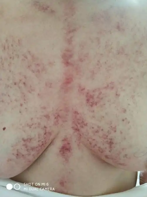 脖子上帮磨的国,出了不多痧,成片的大疱.