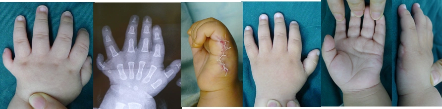 多指畸形概述大量手术实例