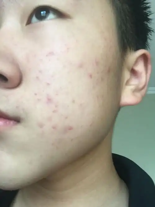 我是一个14岁男生,脸上的痘痘突然多起来了,怎么办啊?