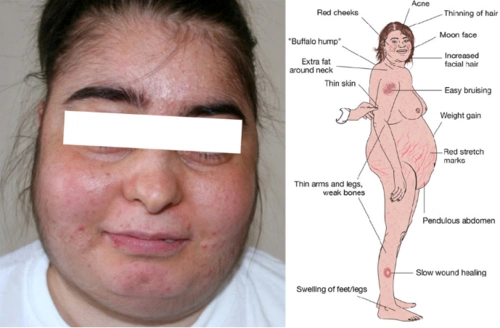 【垂体肾上腺】库欣综合征的流行病学和危害(上) - 好大夫在线