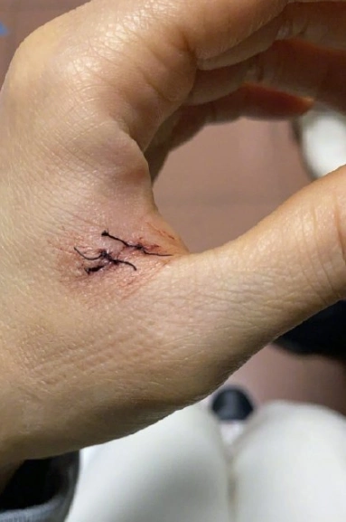 容祖儿范文晒手部受伤照片,透露是自己拆快递剪到了手