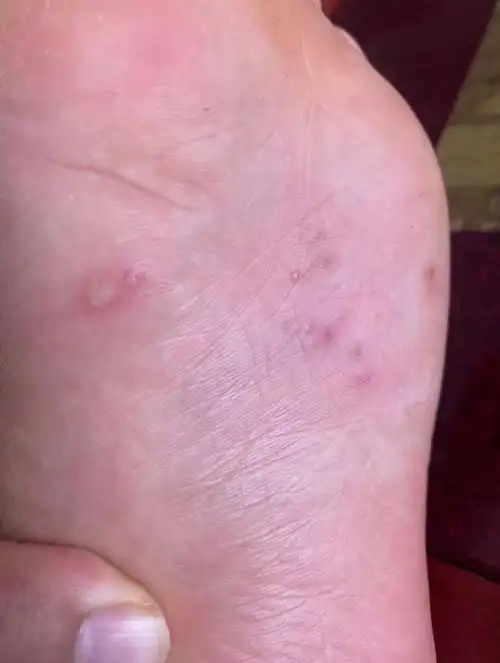 脚底脚心起了好多小水泡,一波下去一波又起.