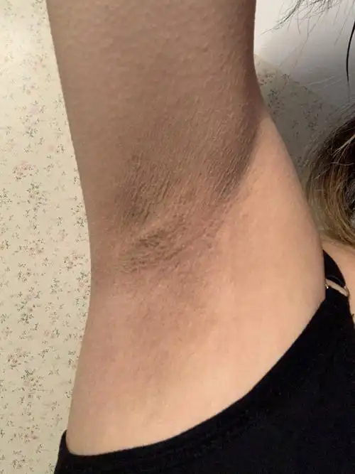 腋下总是很干黑黑的感觉像是垢藏在那里但是一扣就会出血结痂请问要