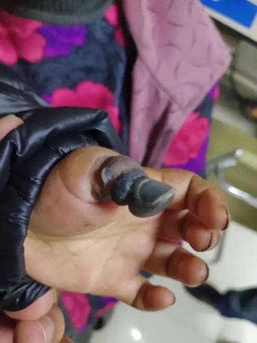 拇指坏死,只因不懂手指包扎法