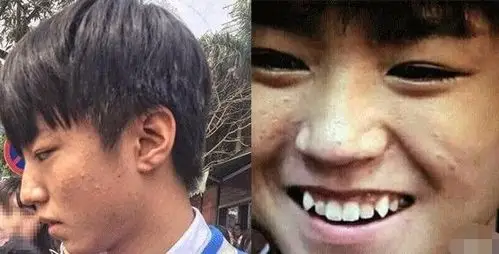 18岁的王俊凯满脸粉刺状况糟糕,颜值不及普通少年!