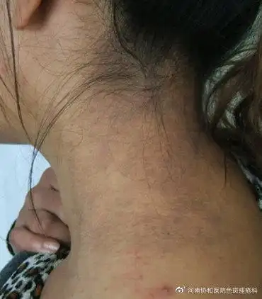 黑变病不是"世纪难题",只是你没有选对方法!