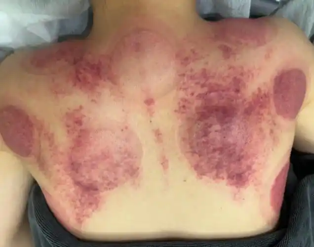 28岁知名女星晒刮痧照背上大片紫红湿气重曾因痛经起不来床