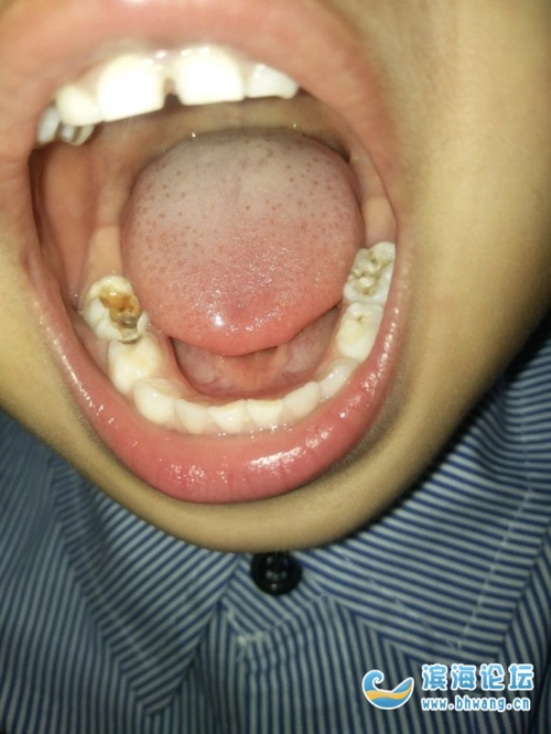 孩子大牙烂得厉害,之前就烂了一点,现在越来越厉害,怎么办?