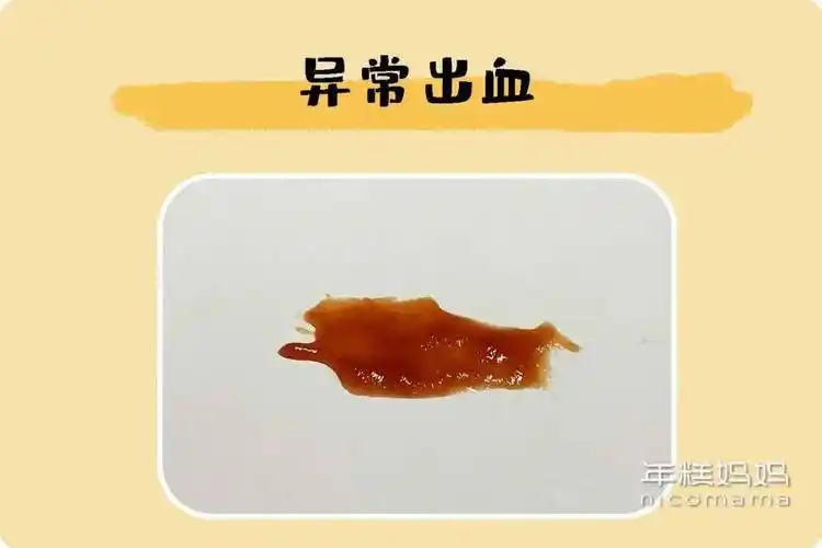 内裤上出现这4种情况,就得多留意了!_分泌物