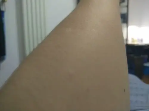 看图实病----米粒大小白斑