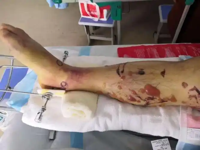 后,排除了血管,神经损伤,决定先为奚先生行跟骨牵引及消肿止痛治疗,待