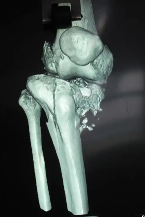 胫骨平台粉碎性骨折急会诊