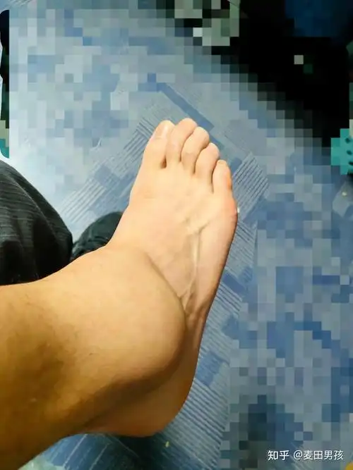 右踝关节扭伤崴脚恢复记录