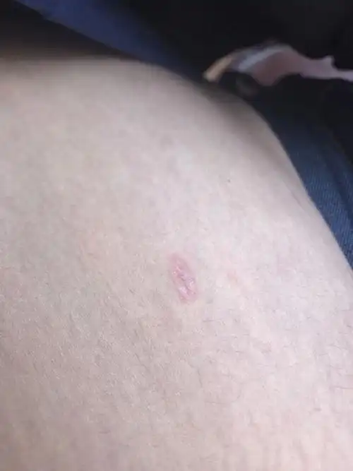 这是什么癣,可有人知道?出汗时有些痒,平时没什么感觉