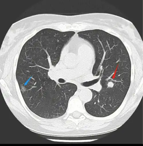 中早期肺腺癌伴淋巴转移