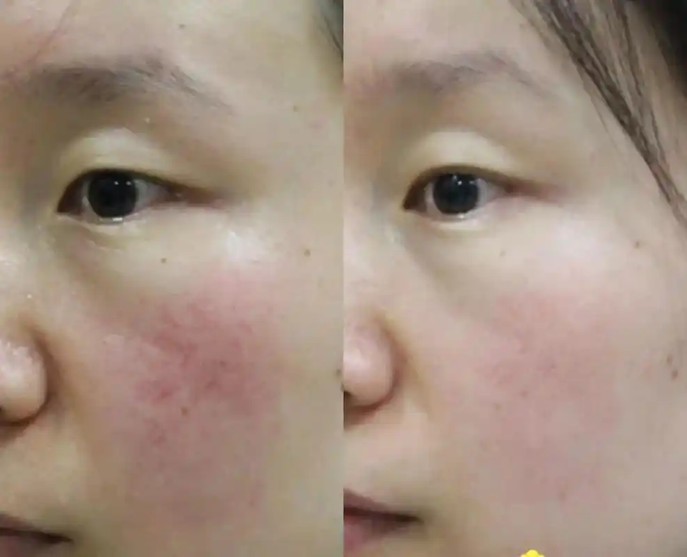 光子嫩肤美白要多少钱(光子嫩肤美白要多少钱一次)