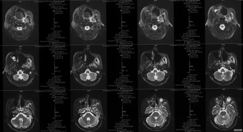 解放军八五医院rapidarc瑞普达治疗上颌窦癌