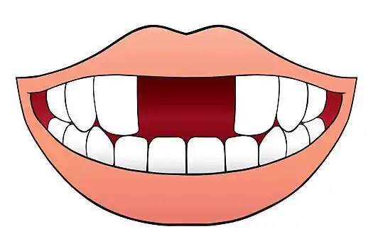 两个,正面,牙齿,卡通,嘴,掉牙