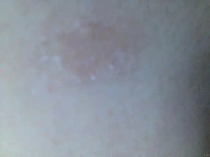 与今天中午吃了炒羊肉,在晚上洗澡时发现身上长了几块癣