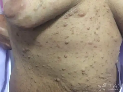 牛奶咖啡斑长这样!—一个好听不好看的名字