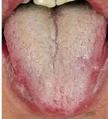 舌头就是健康"显示器",从3个方面教你中医辩证,简单易懂!