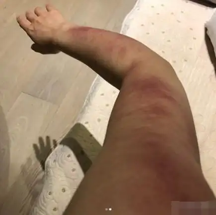 搜狐娱乐讯 近日,杨丞琳透过社交媒体晒出两张手臂刮痧照片,并写道:"