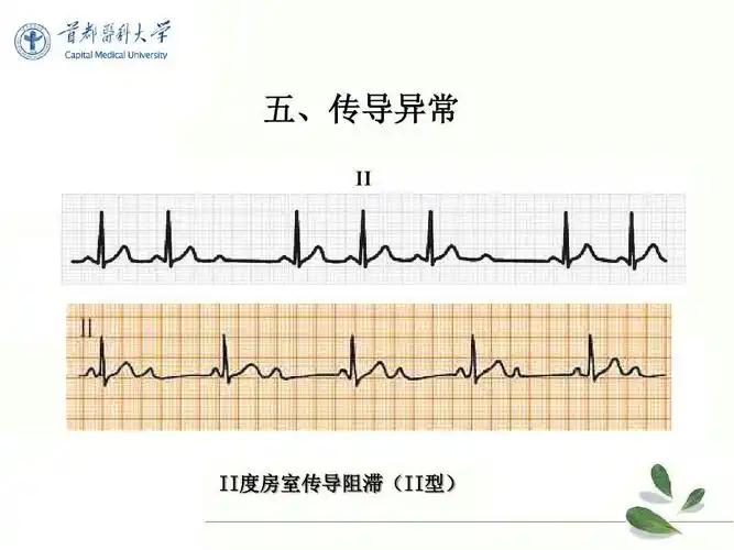 2[1].异常心电图-心律失常ppt_word文档在线阅读与下载_免费文档