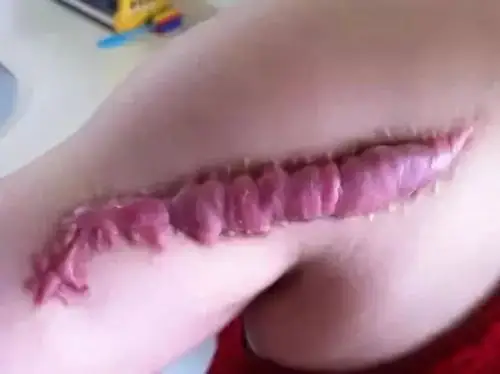 评价:根据我实践经验,单纯使用三七粉效果一般,建议配合外科手术治疗