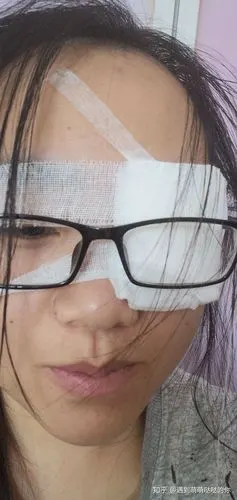 刚拆纱布时由于伤口结痂等情况,眼睛还很难睁开,可以用棉棒蘸低浓度