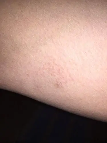 大腿内侧两侧皮肤这样了!平常不痛!走路搓到裤子有点感觉!也不痒!