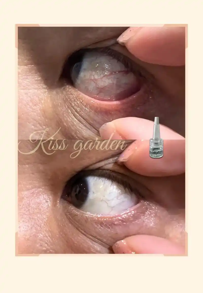 熬夜党请看过来……蕞近发现自己的眼睛突然变红了或有明显红血丝