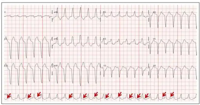 这种心电图要警惕地高辛中毒